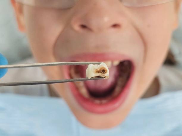 Best Emergency Wisdom Teeth Removal in Revere, MA